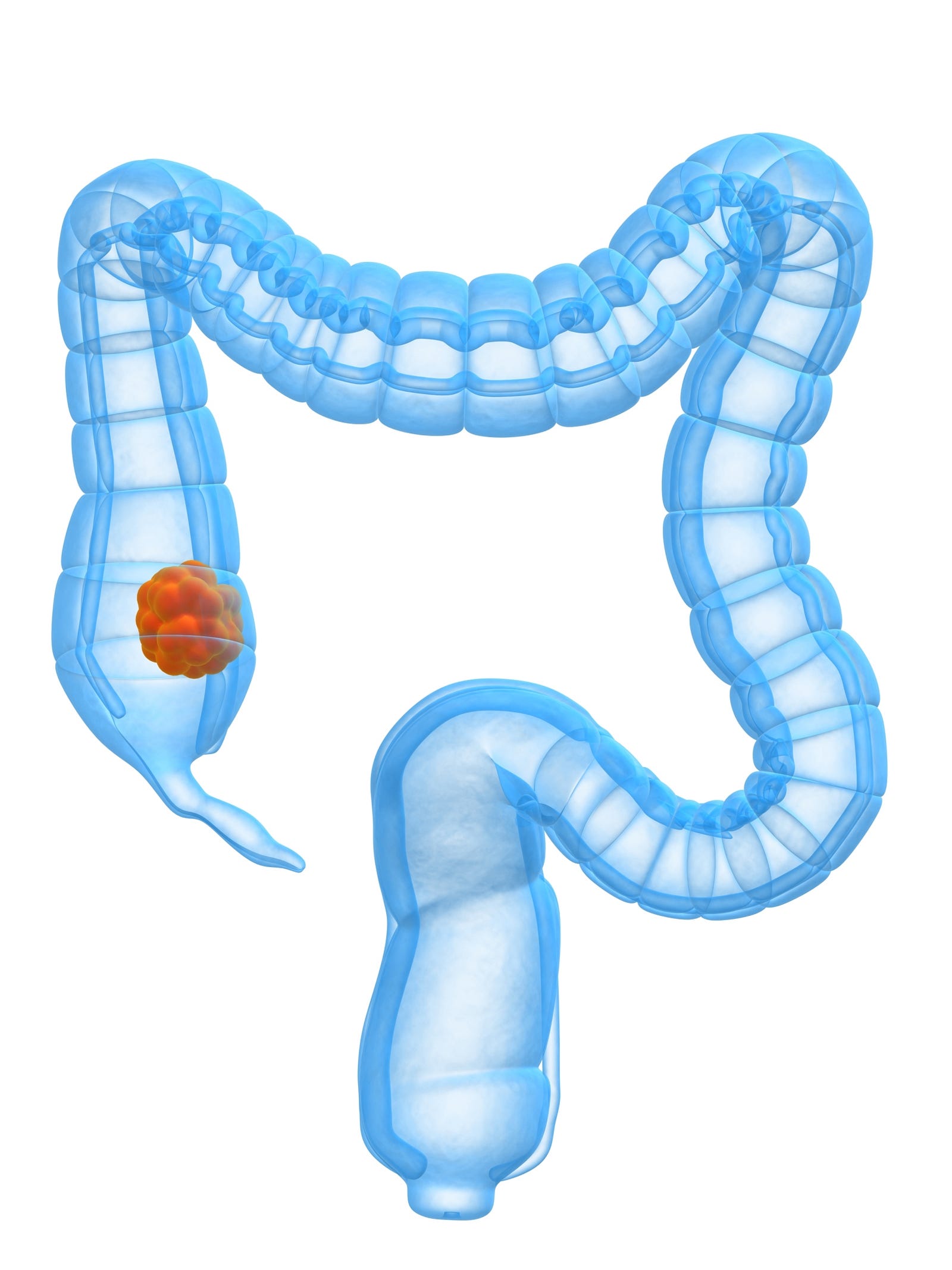 A cartoon drawing of the colon, colored blue. At the lower left side of the image (in the ascending colon) is a red-colored tumor. The colon is light blue. Colorectal incidence and mortality is rising among young adults.