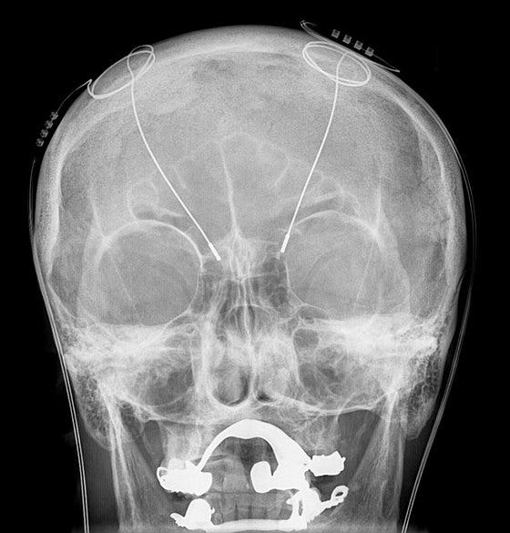 Frontal X-ray of a skull with thin wires extending from the top (vertex) to the middle of the brain. Deep brain stimulation probes are shown in an X-ray of the skull (white areas around the mouth are metal dentures unrelated to DBS devices).