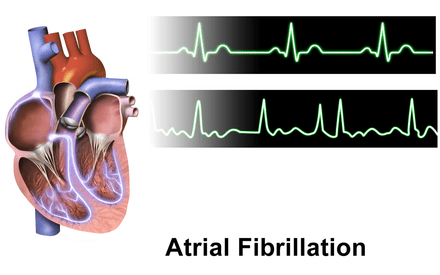 Normal heart rhythm tracing (top) Atrial fibrillation (bottom).