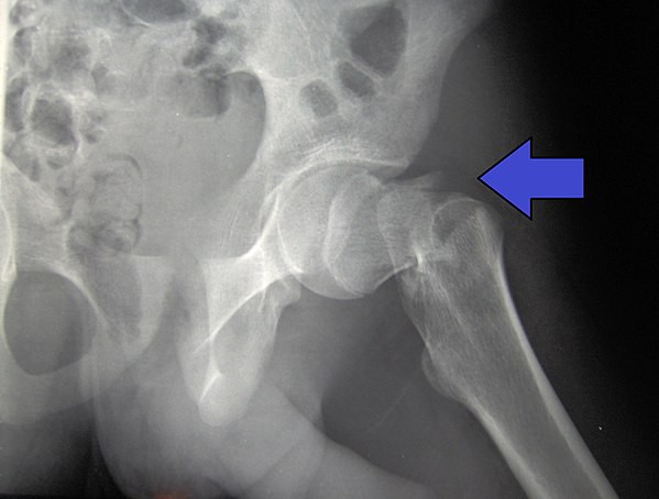 An X-ray of a left hip fracture. The black and white image shows the top of the femur nearly cut across its entire width, with slight displacement. A blue arrow points to the hip fracture.