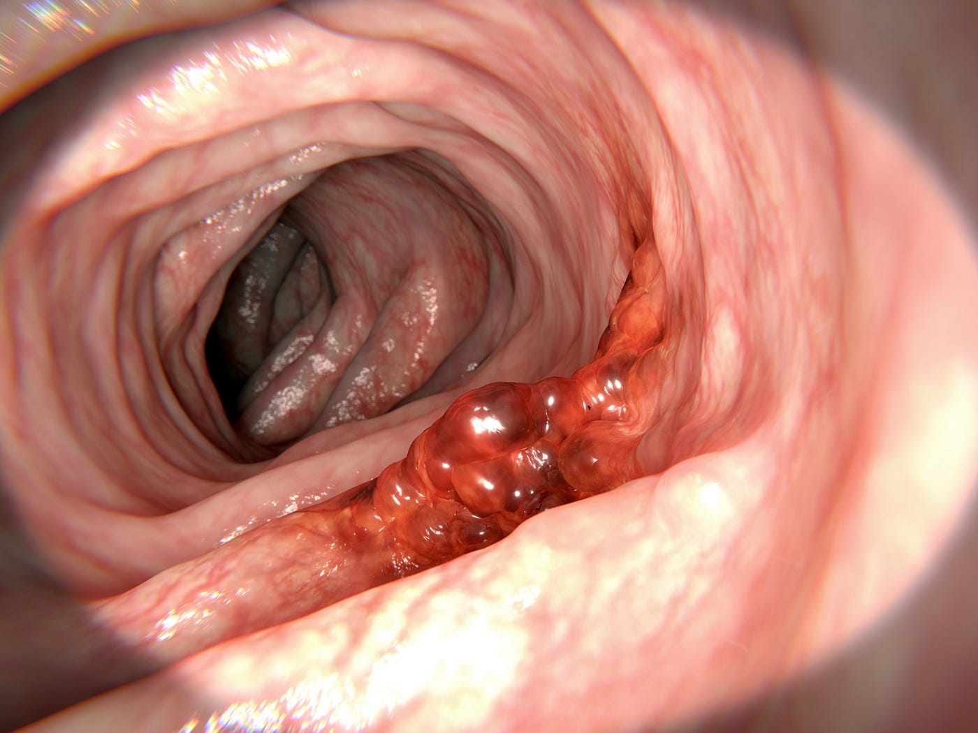 A view through a colonoscope. We see cancer on the lower wall of the colon. THe cancer is reddish, gelatinous, and irregular. It rises from the colon wall. There are 7 lifestyle maneuvers that can lower colorectal cancer risk.
