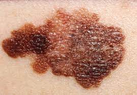 Brown, irregular skin lesion on white skin. It is a melanoma.