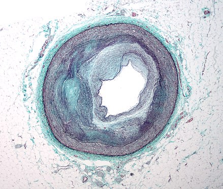 Micrograph of an artery that supplies the heart showing significant atherosclerosis and marked narrowing. We see the arter in cross section.