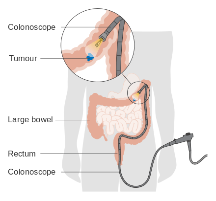 Illustration of a colonoscopy. We see a the colonoscopy entering the colon from below.