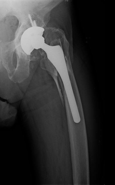 X-ray image of a fracture of the left upper leg (femur), with surgical rod in place.